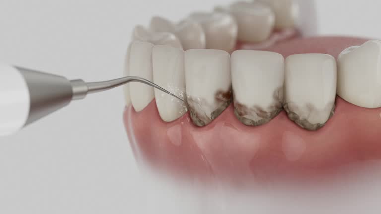 Reliable Dental Veneers contractor in Buda, TX by Smile Center Dentistry